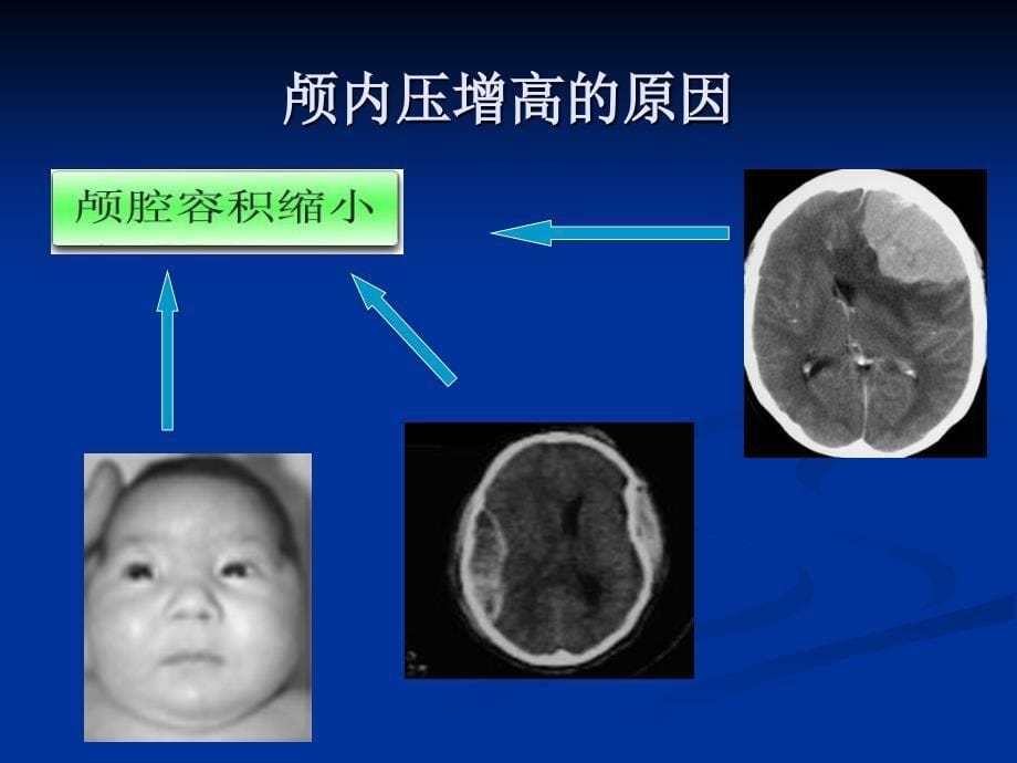 唐贝颅内压增高病人的护理精选文档_第5页