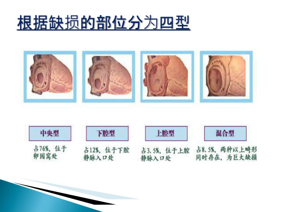 房间隔缺损封堵术的护理_第4页