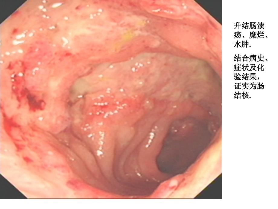 最新6腹部结核多媒体100324PPT文档_第1页