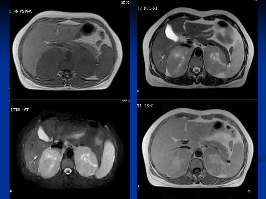 双侧肾上腺原发性淋巴瘤例_第4页