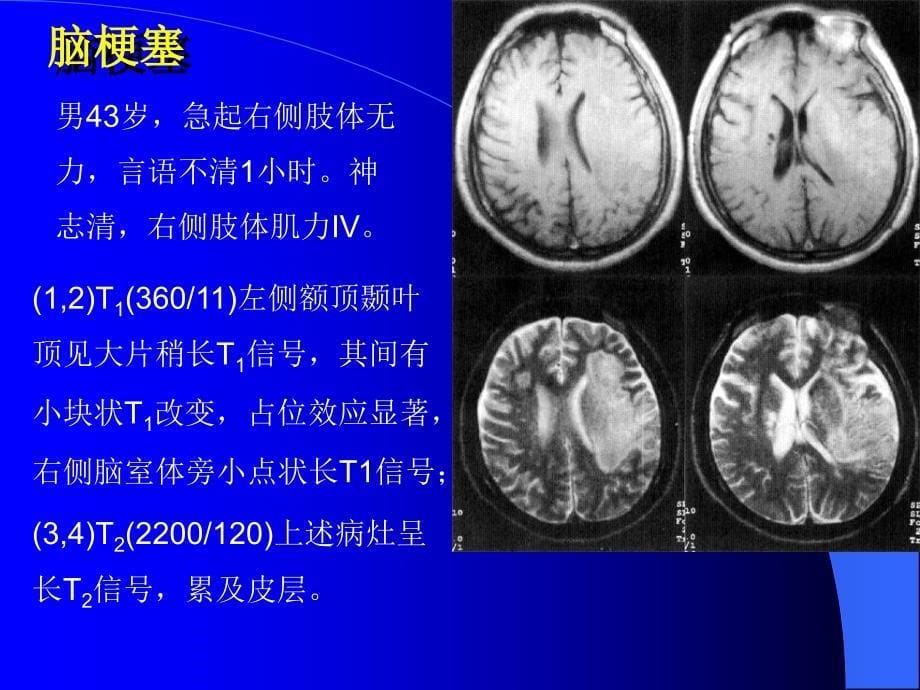 10MRI图像脑1文档资料_第5页