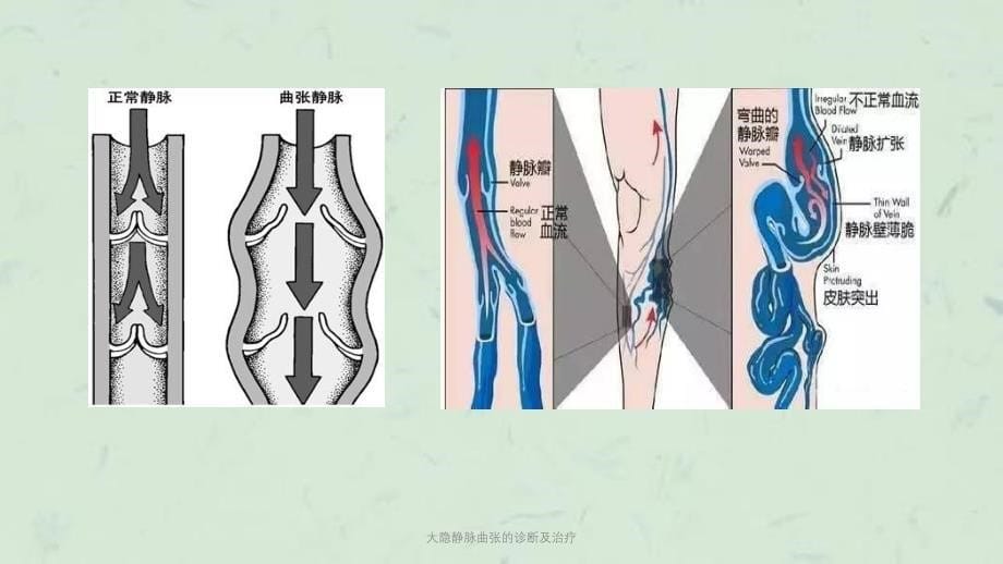 大隐静脉曲张的诊断及治疗课件_第5页