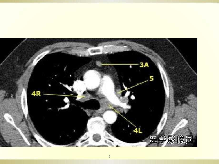 肺癌淋巴结转移的规律ppt课件_第5页