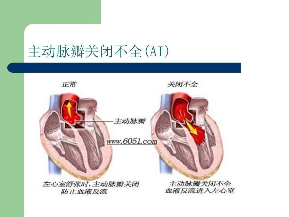 主动脉瓣关闭不全护理精品ppt_第3页