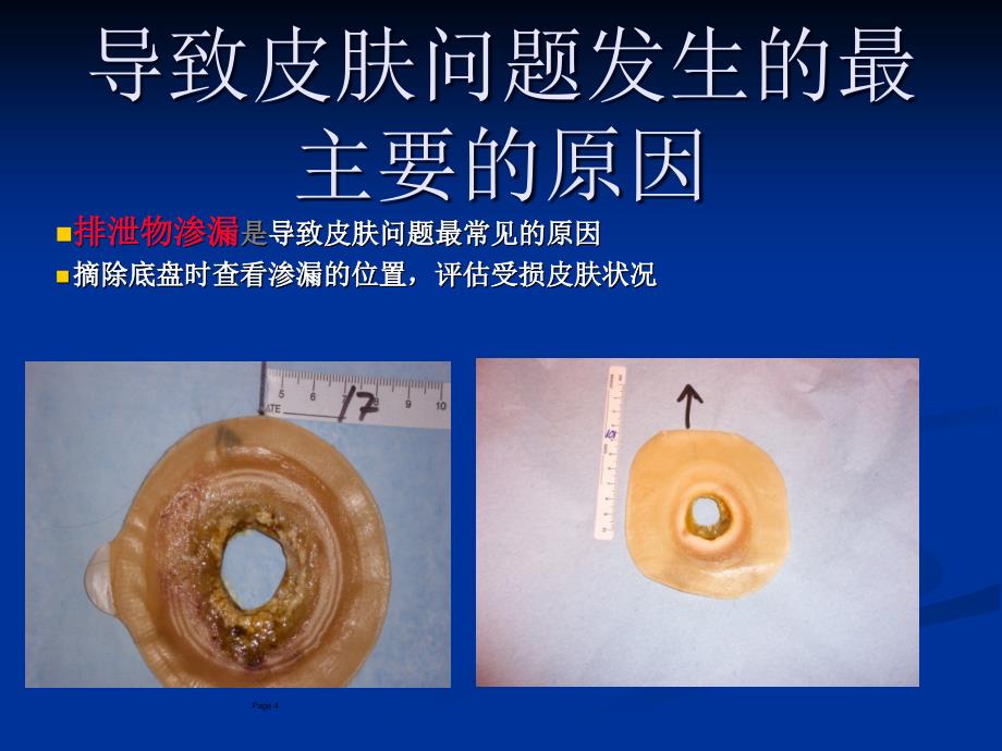 造口及造口周围并发症的处理课件_第4页