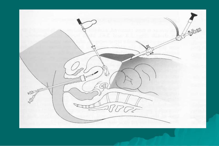 腹腔镜在妇科的应用_第4页