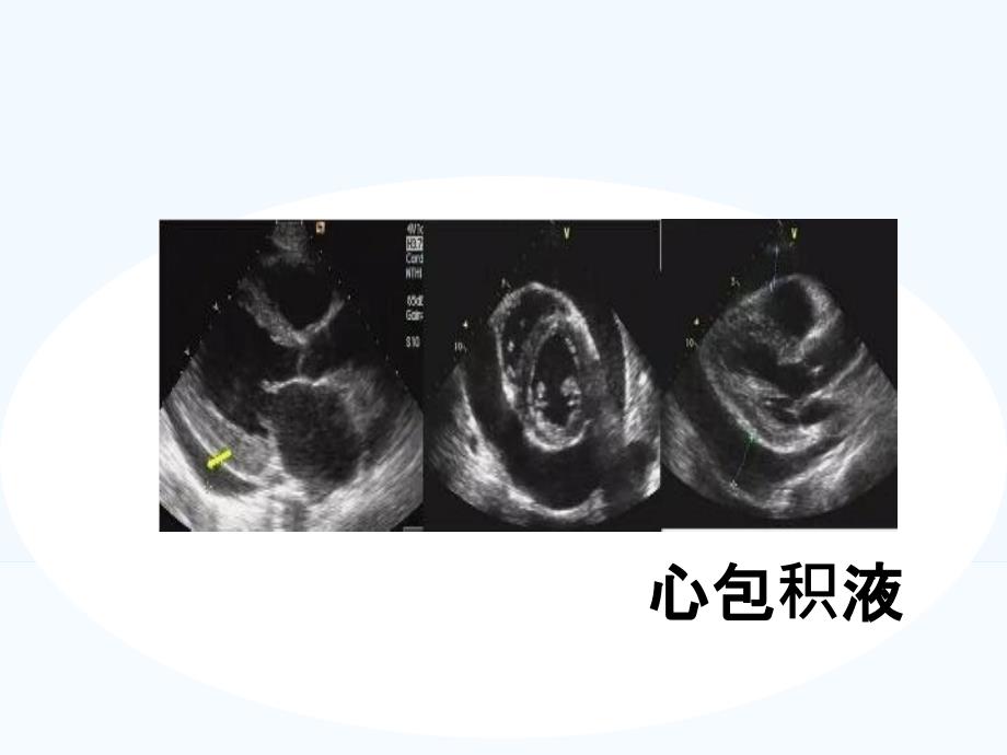 体腔积液的超声测量_第4页