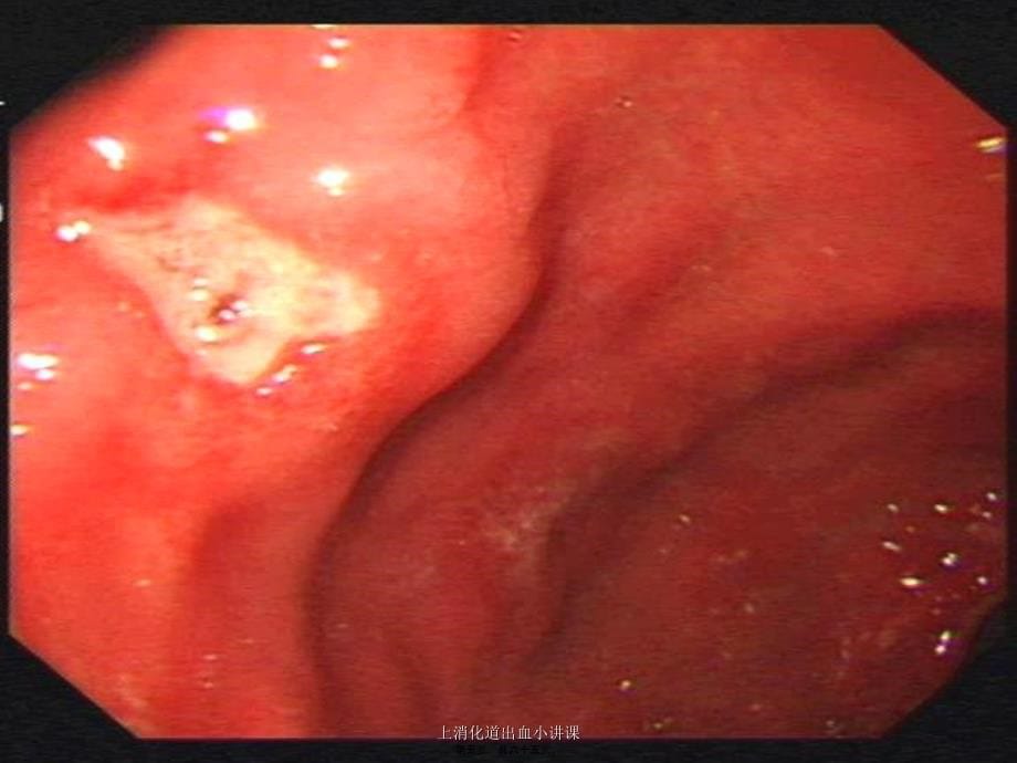 上消化道出血小讲课课件_第5页