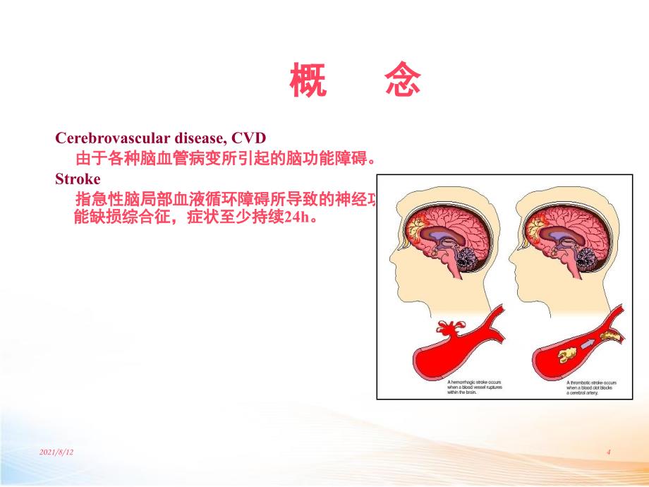 脑血管疾病 课件讲座_第4页