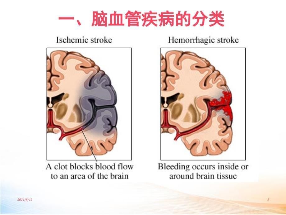 脑血管疾病 课件讲座_第5页