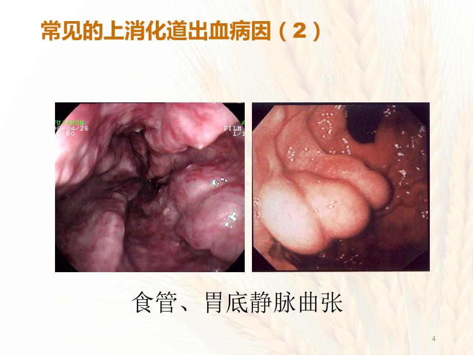 上消化道出血的诊治思维_第4页