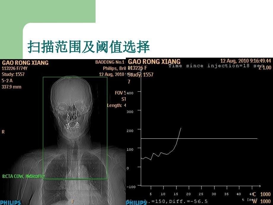 排螺旋CT在头颈部血管的应用_第5页