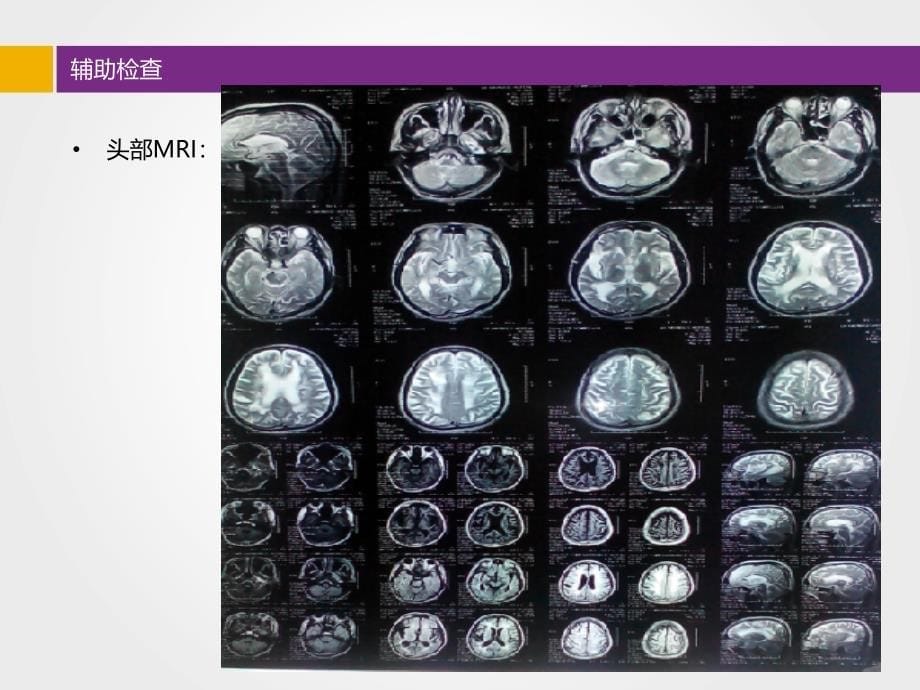 ACS病例分享_第5页