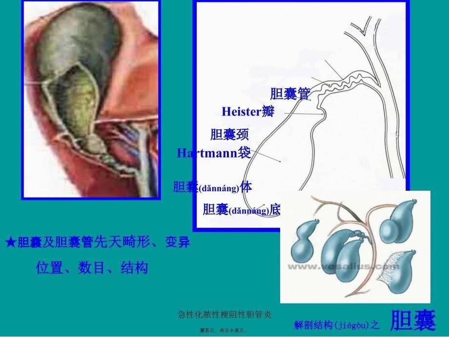 急性化脓性梗阻性胆管炎课件_第5页