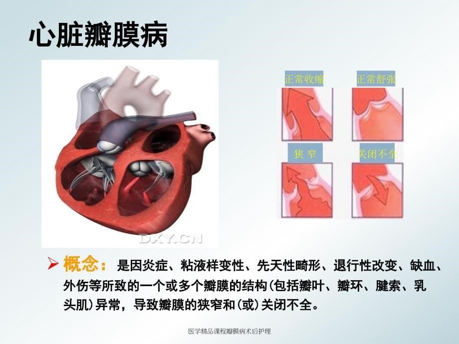 医学精品课程瓣膜病术后护理课件_第5页