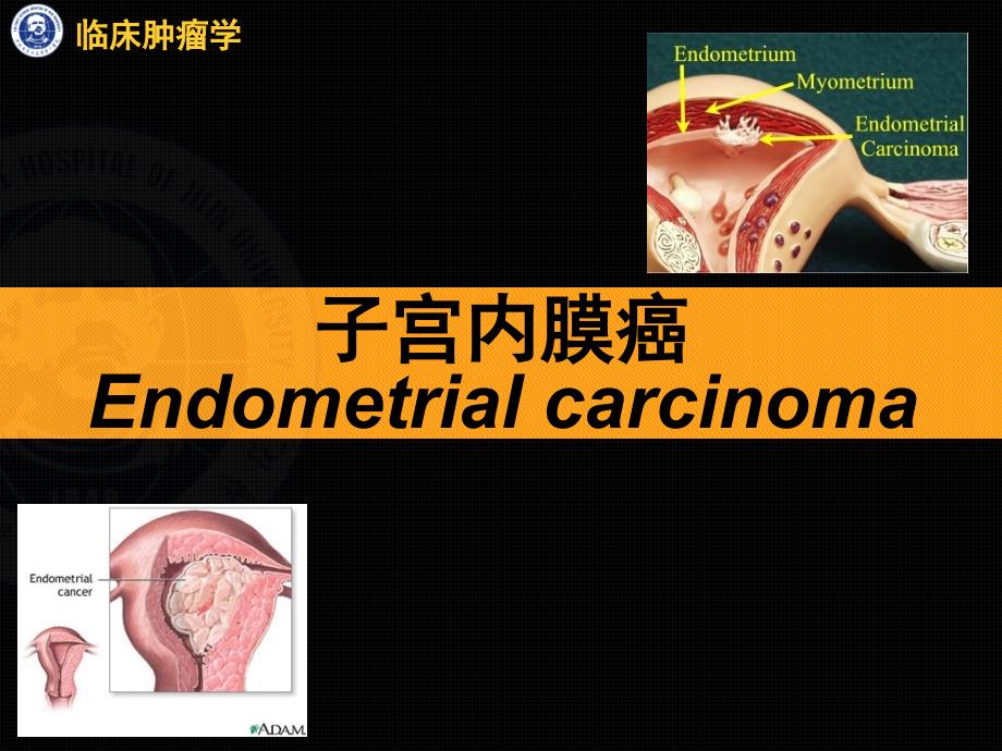 临床肿瘤学：子宫内膜癌_第1页