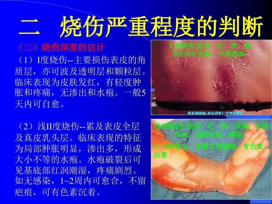 烧伤的现场急救演示PPT_第5页