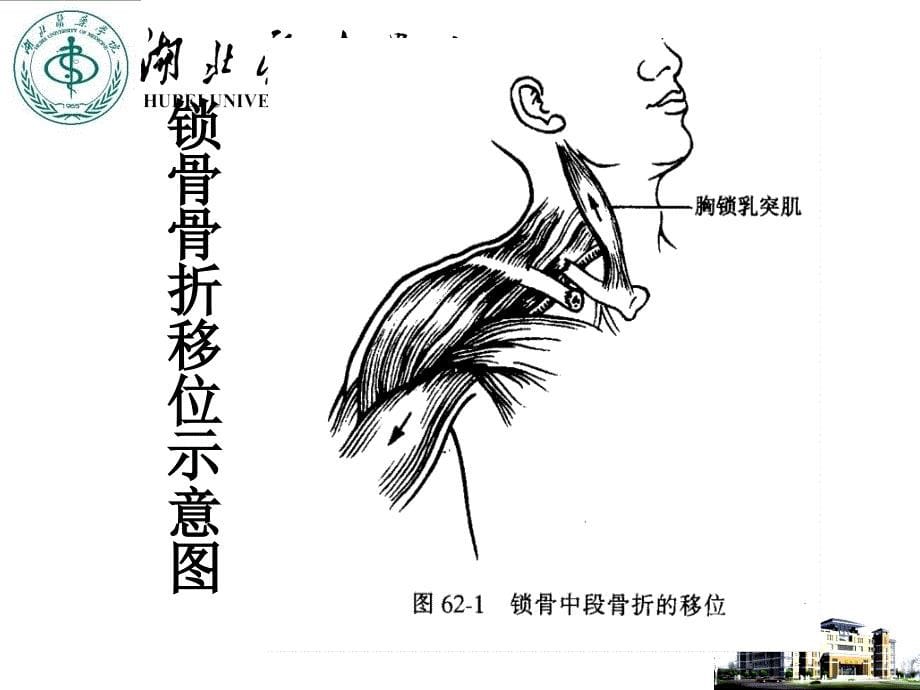 外科学教学课件：上肢骨、关节损伤1_第5页