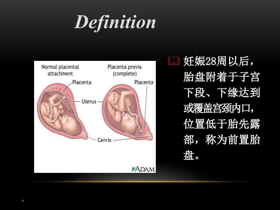 （精选课件）前置胎盘的诊断、预防和处理_第5页