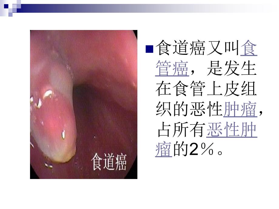 食道癌ppt课件_第2页