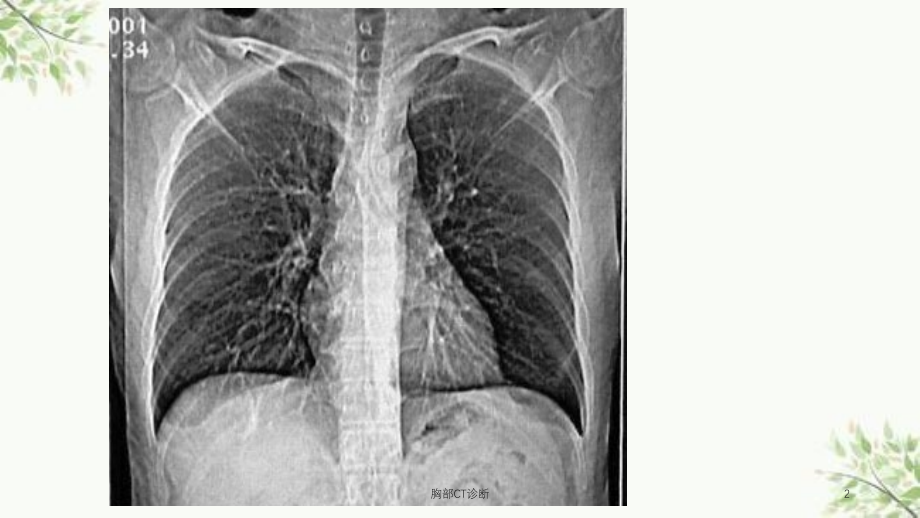 胸部CT诊断课件_第2页