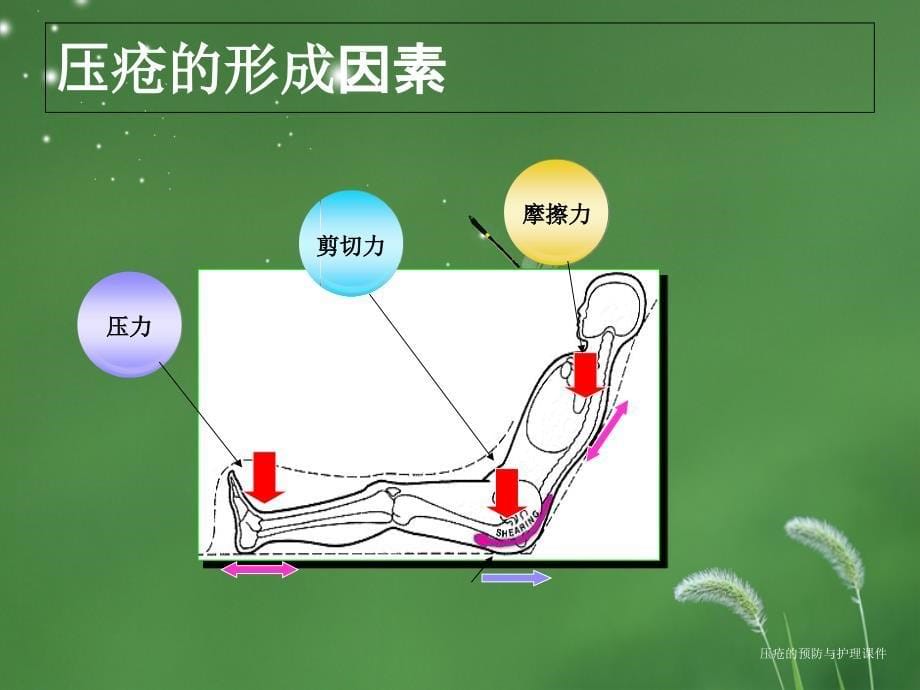 压疮的预防与护理课件_第5页