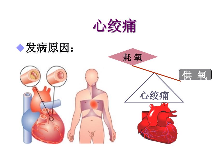 新抗心绞痛药春季_第4页