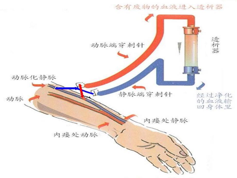 动静脉内瘘 演示文稿课件_第5页