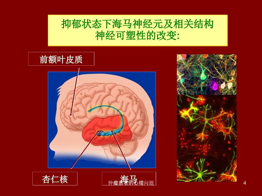 肿瘤患者的心理问题课件_第4页