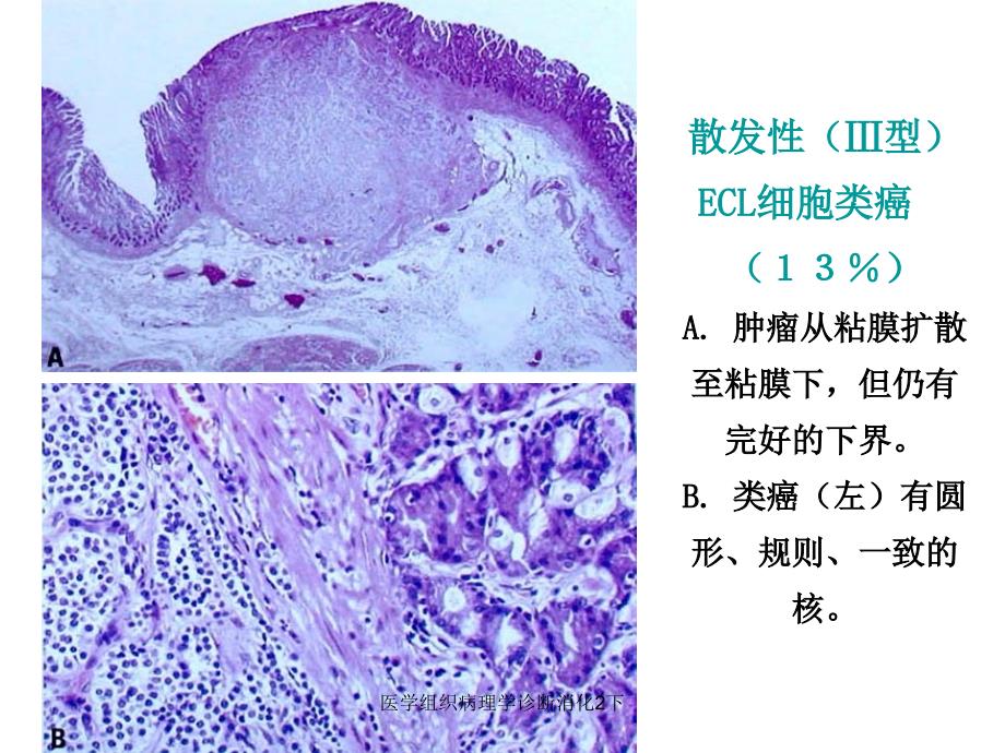 医学组织病理学诊断消化2下课件_第4页