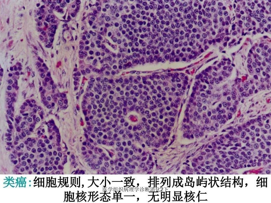 医学组织病理学诊断消化2下课件_第5页