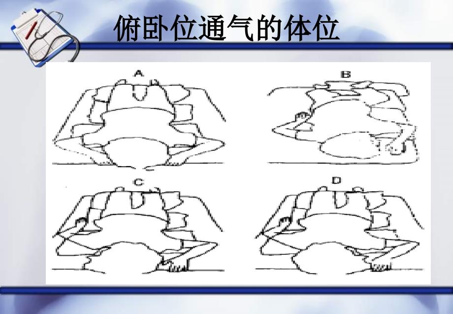 俯卧位通气原理_第4页