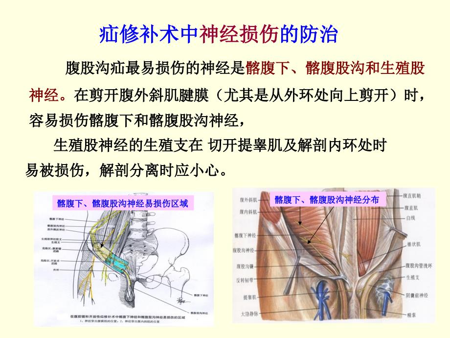 无张力疝修补术后损伤及并发症_第4页