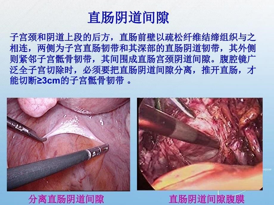 腹腔镜广泛子宫切除难点及技巧_第5页