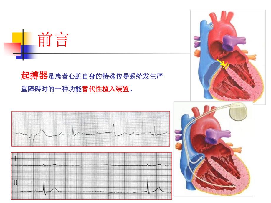 起搏器计时间期的意义_第2页