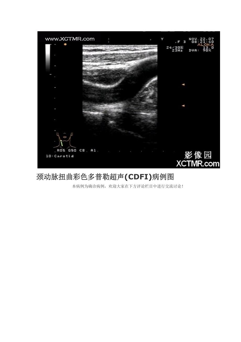 颈动脉扭曲彩色多普勒超声(CDFI)病例图.doc_第3页