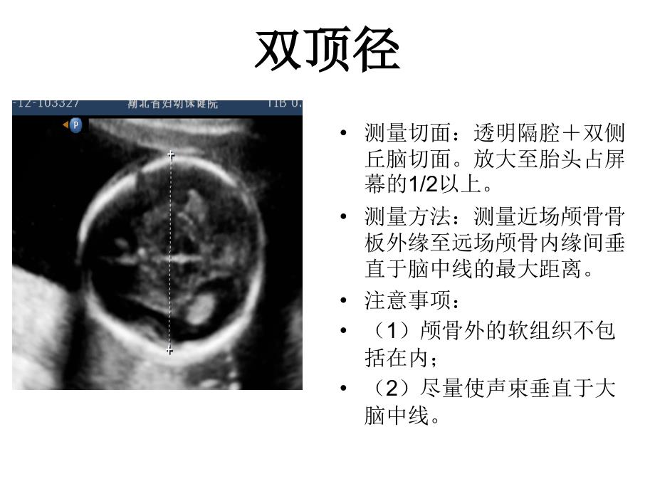 产科超声标准切面25张图_第1页