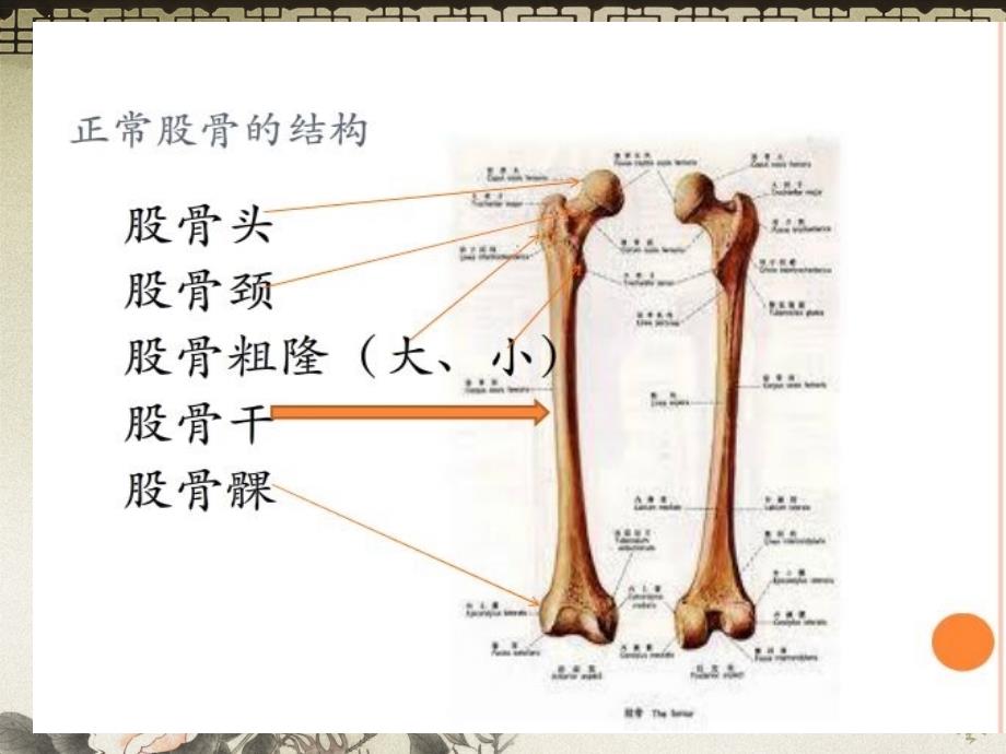 股骨干骨折护理修改后ppt课件.ppt_第3页