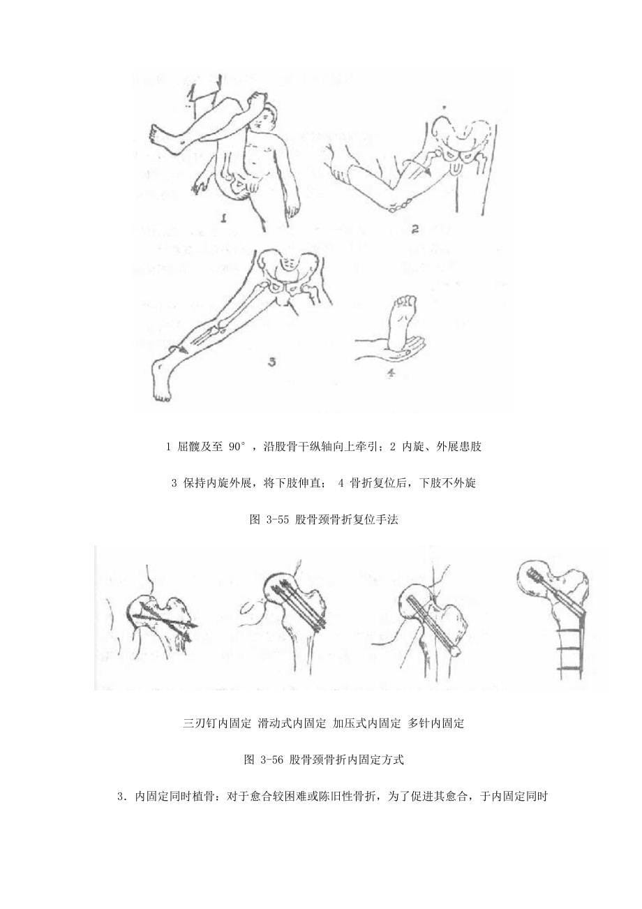 第三章 下肢骨折_第5页