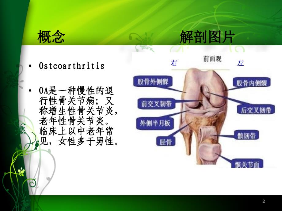 膝关节骨性关节炎护理查房课件_第2页