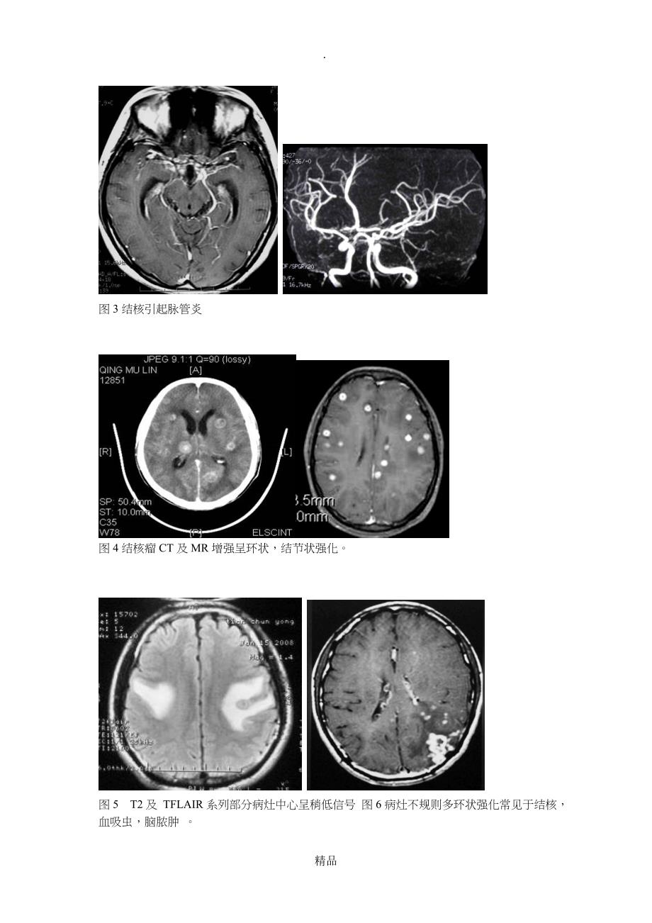 脑结核CT诊断及MRI诊断_第3页