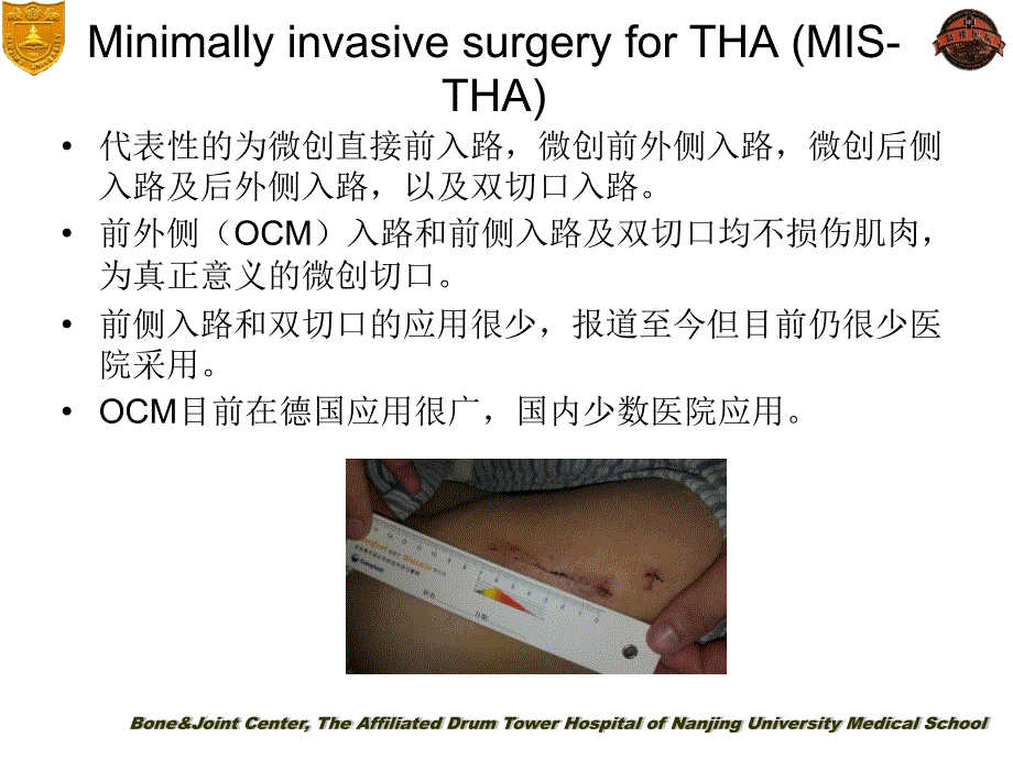 ocm入路小切口全髋关节置换ppt课件_第3页