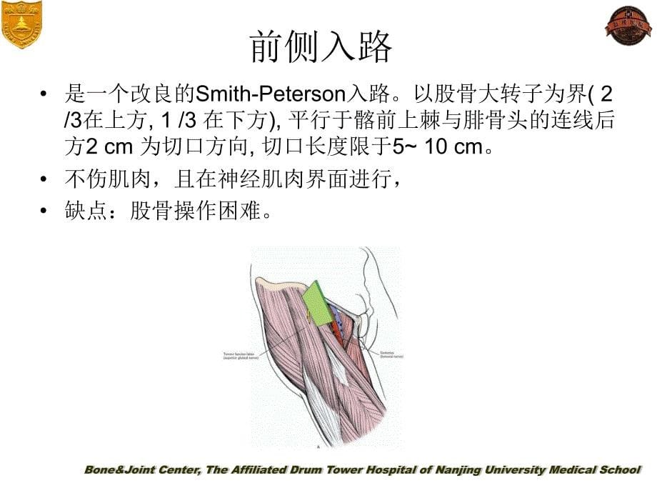 ocm入路小切口全髋关节置换ppt课件_第5页