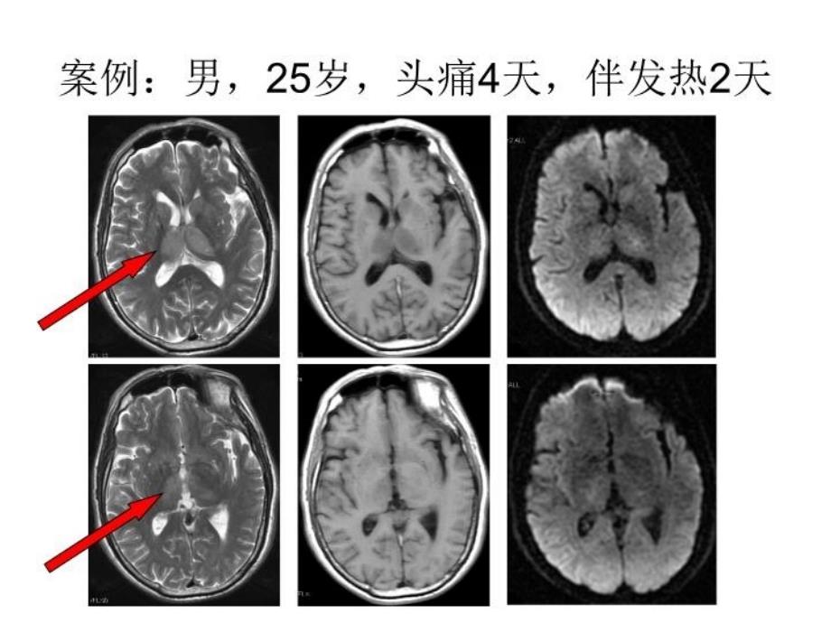 最新大脑内静脉及其属支的MRV成像研究教学课件_第3页