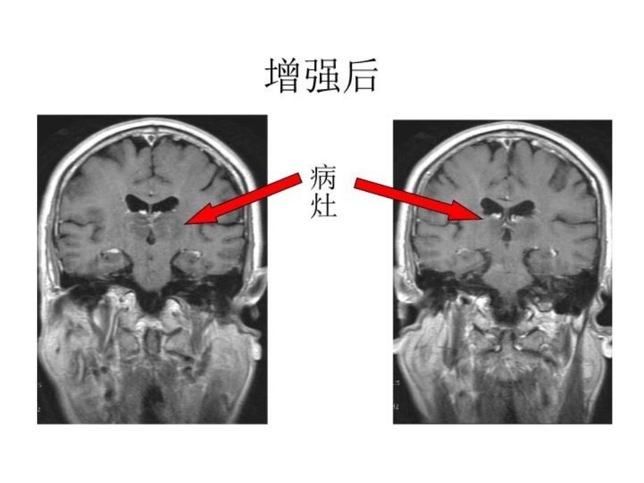 最新大脑内静脉及其属支的MRV成像研究教学课件_第4页