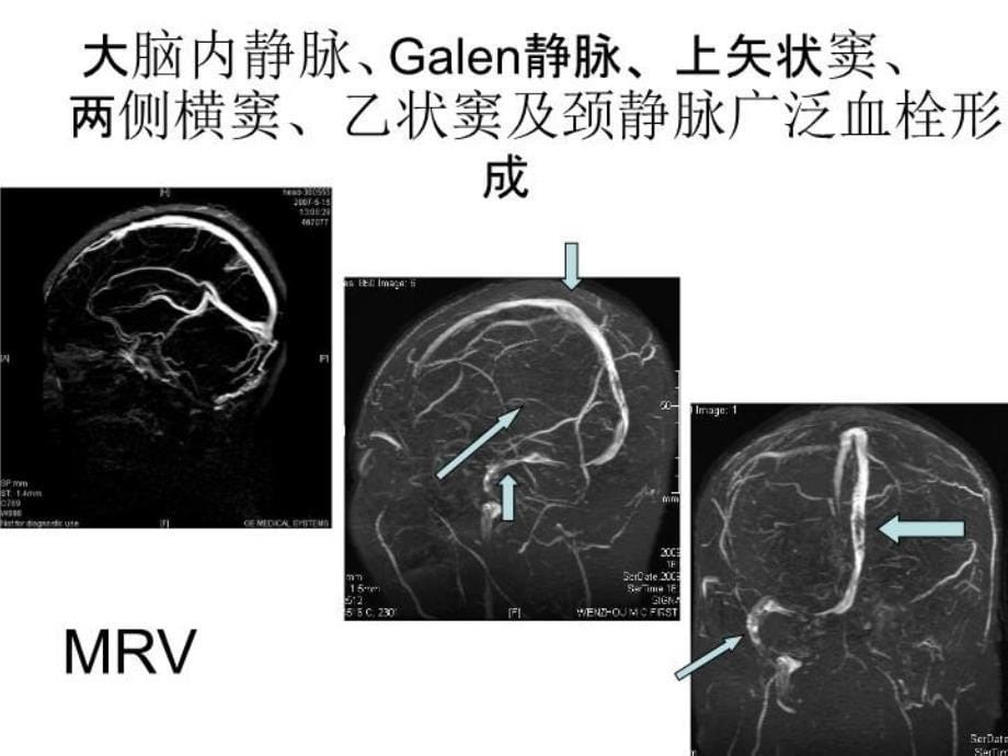 最新大脑内静脉及其属支的MRV成像研究教学课件_第5页