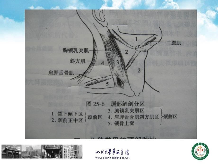 颈淋巴结分区及清扫术式分类课件_第5页