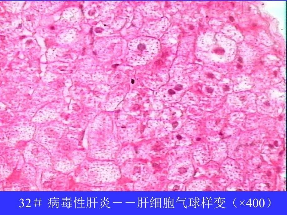 实验九消化系统疾病和消化系统肿瘤文档资料_第5页