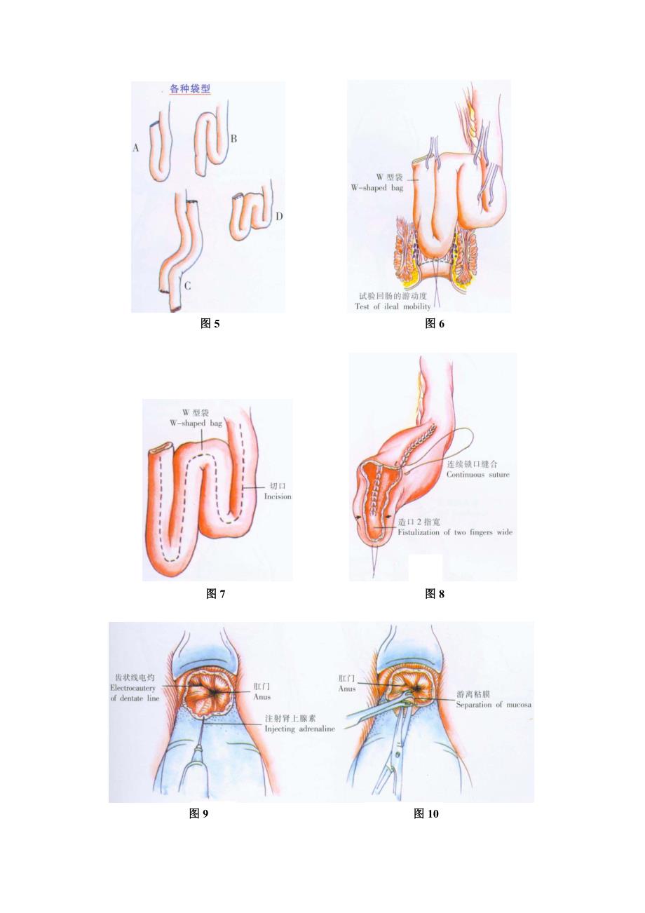 回肠、肛管吻合术.doc_第4页