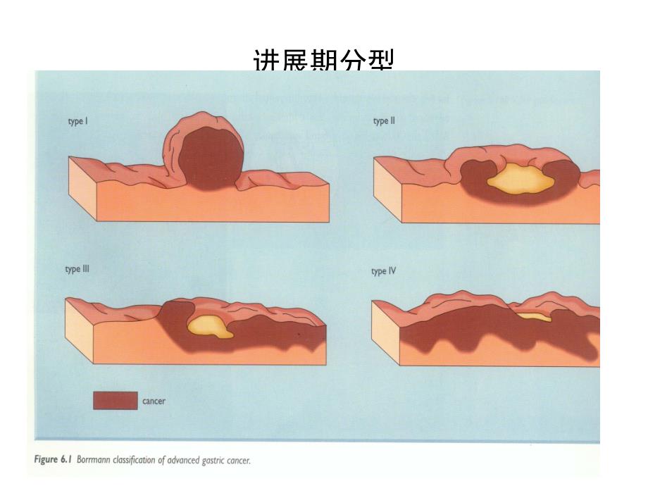 胃癌护理常规.ppt_第4页